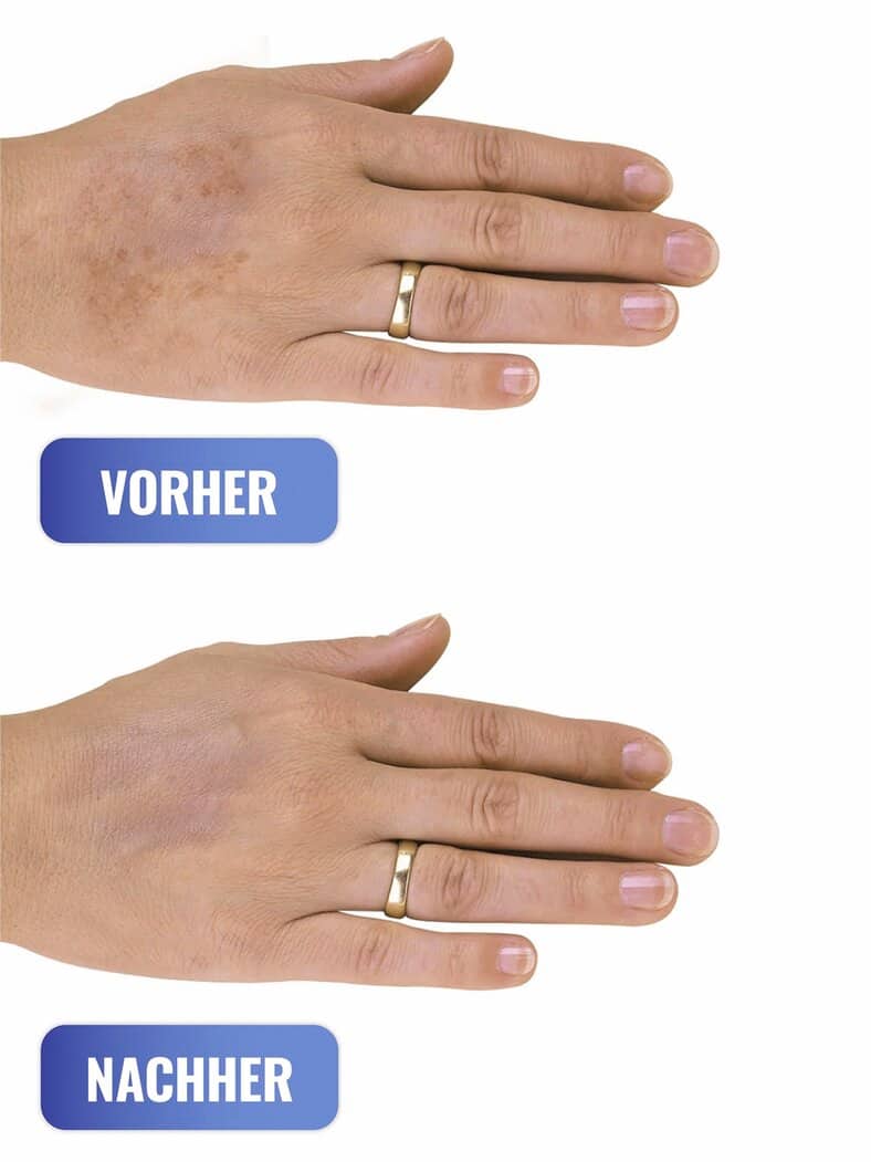 Altersflecken-Ex Roll-on Transparent