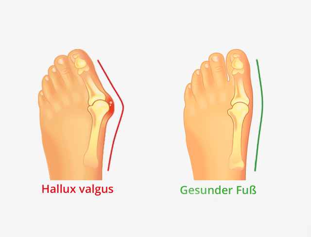 Diagramm zeigt links einen Fuß mit Hallux valgus und rechts einen gesunden Fuß, mit Markierungen in Rot und Grün.
